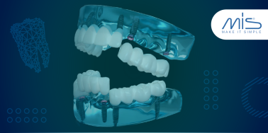 "All on Six" System with Mis Implants **